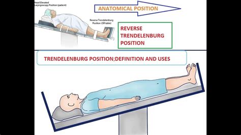 trendelenburg position nursing