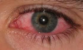 eye infection treatment clinton township mi