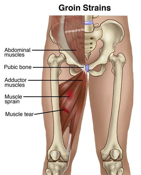 Groin Strain Diagnosis And Treatment