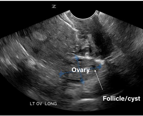 3 Transvaginal Pelvic Ultrasound Protocol – My Blog