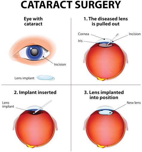 What Are Cataracts And How Are They Treated Craftoptics