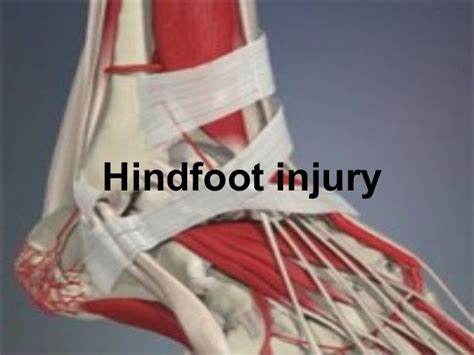 hindfoot injury
