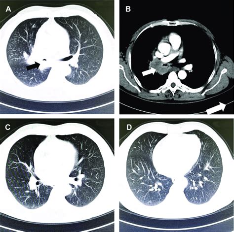 Chest Ct On Admission The Lung Window Of The Left Upper Lobar Bronchus