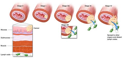 Pathology Outlines Staging