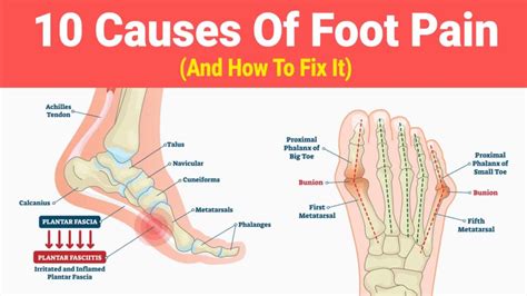 Flat Feet Pain Wholesale Dealer Save 60 Jlcatj Gob Mx