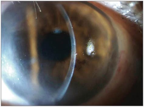 A Woman With Intraocular Inflammation After Descemet Membrane