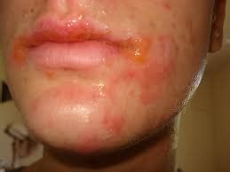 impetigo spain   case reports symptoms