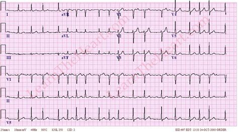 Atrial Fibrillation With Rapid Ventricular Rate Ecg Example 1 Learn