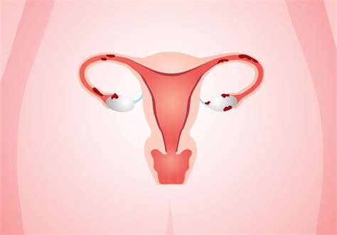 Diagnosis And Treatment The Endometriosis Clinic