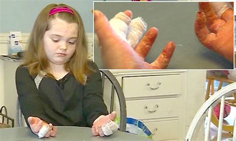 massachusetts girl who made slime left with burns daily mail online