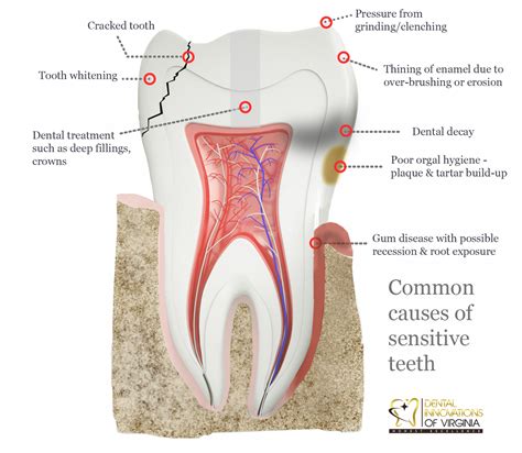 sensitive teeth  sensitive gum lansdowne va family dentistry