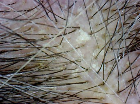 morgellons disease awareness morgellons hair
