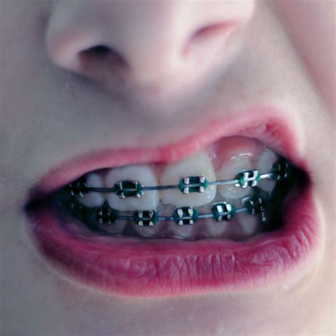 healthcare braces tells you when they need to be fastened reattached
