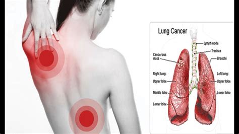 Lung Cancer Symptoms All Most Common Signs Of Lung Cancer Full Hot
