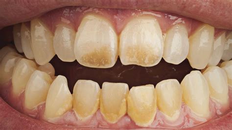 dents jaunes chez l adulte et l enfant raisons quoi faire et comment