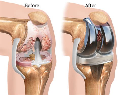 knee replacement surgery recovery time complications