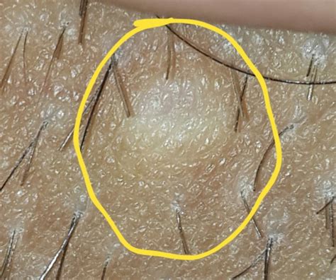 this might be a genital wart caused for hpv sexual health forums