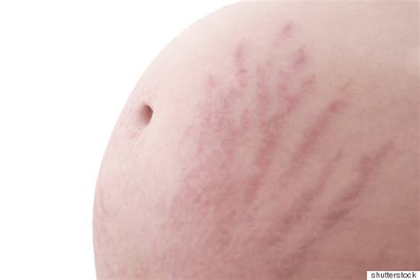 did you suffer from stretch marks during pregnancy global women connected