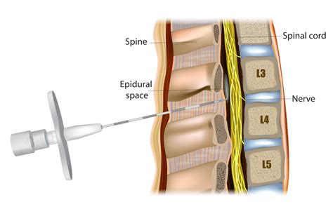 spinal block  epidural differences similarities