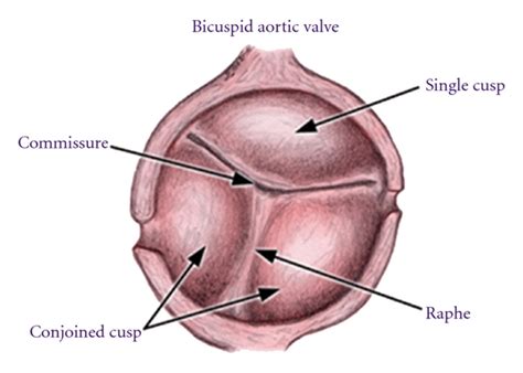 Bicuspid Aortic Valve Disease A Comprehensive Review