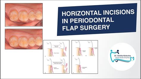 types  flap  periodontal surgery design talk