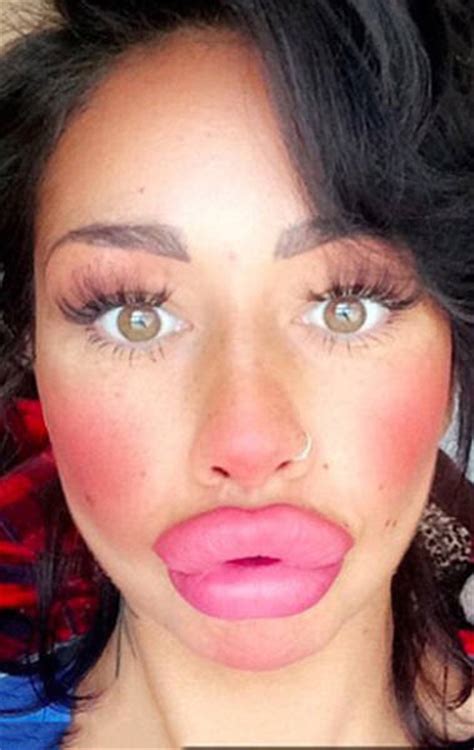 This Mum Has Already Huge Lips But She Wants Them Even