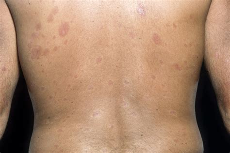immunosuppressants effective  early diffuse cutaneous systemic