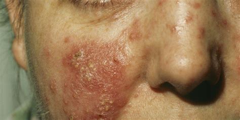 could you have rosacea—or is your skin just red women s health