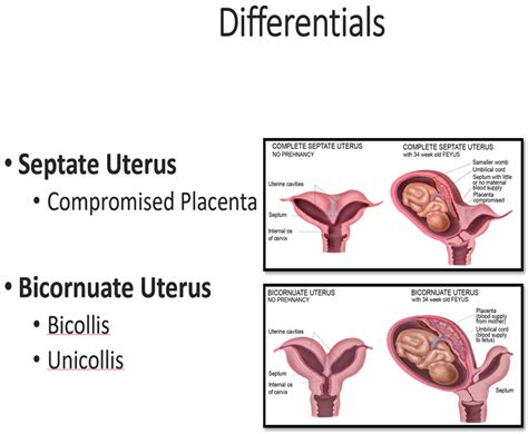 Uterine Didelphys In A Pregnant Mother