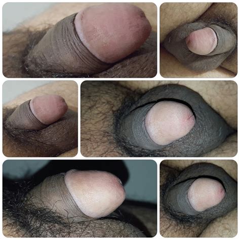 circumcised penis photo big teenage dicks