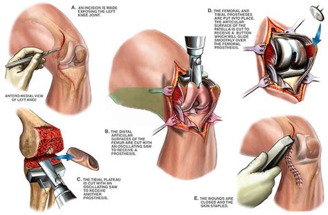 How To Take Care Of Joints After Hip Or Knee Replacement