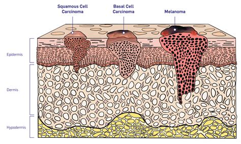 Nmsc Keratinocyte Cancer Mscan