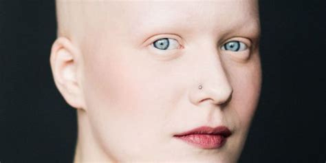 7 Brave Beautiful Photos Of Women With Alopecia