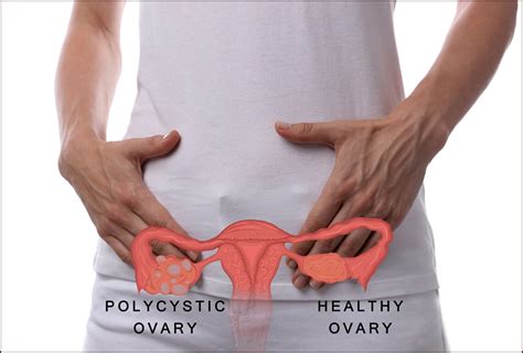 Understanding Pcos Causes Symptoms And Treatment