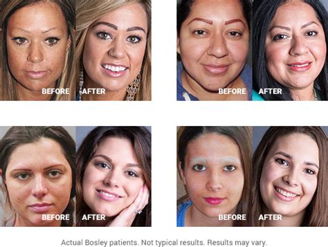 eyebrow restoration hair restoration eyebrow transplant