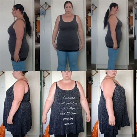 Gastric Bypass Surgery Before And After Pictures Past