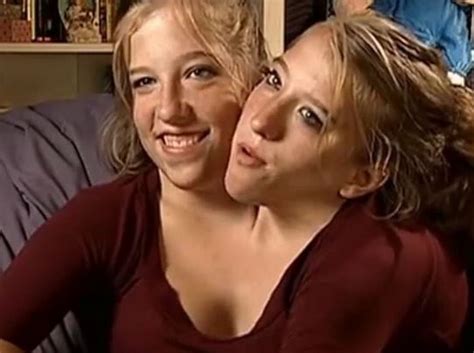 Difference Between Conjoined Twins And Siamese Twins