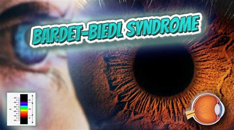bardet biedl syndrome obn