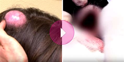 see this woman s 20 year old egg size head cyst get ripped
