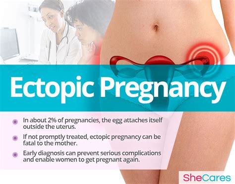 ectopic pregnancy shecares