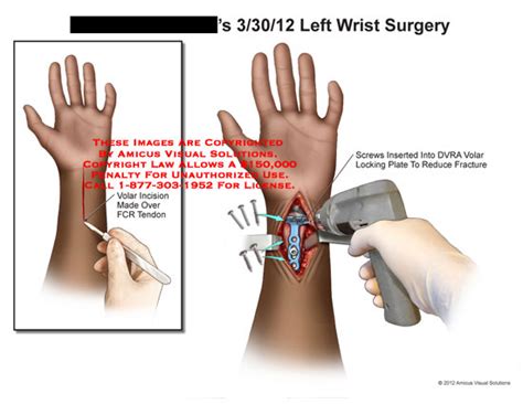 left wrist surgery