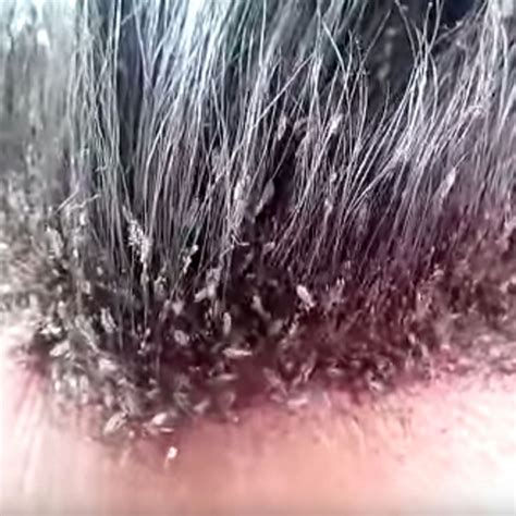 girl  dies  mother applied pesticide   lice infested hair