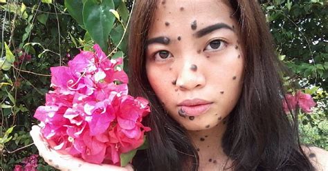 20 Year Old Whose Body Is Covered In Moles Opens Up About Self Love And