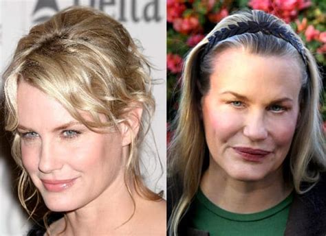 celebrity daryl hannah botox plastic surgery before and