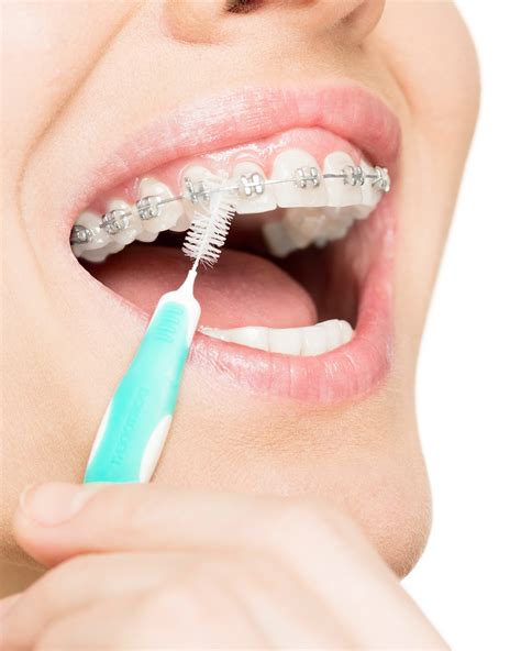 diy dental care   clean braces