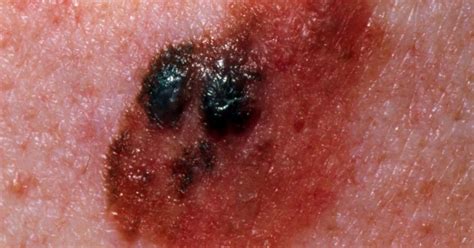 Stage 4 Melanoma Survival Rate Pictures And Treatment