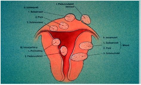 Uterine Fibroids Benign Uterine Growths Tennessee Fertility Specialists