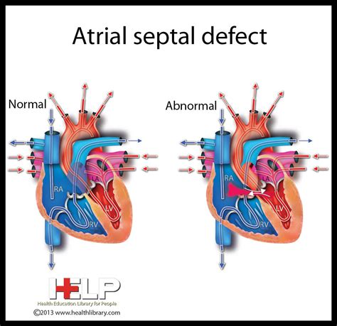 atrial septal defect technical term  laycis condition neonatal