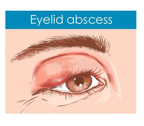 sluit omhoog van een oog met een besmet ooglid vector illustratie illustratie bestaande uit