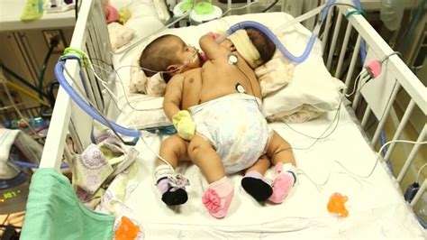 Doctors Prepare For Conjoined Twins Surgery